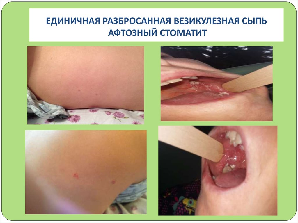 ЕДИНИЧНАЯ РАЗБРОСАННАЯ ВЕЗИКУЛЕЗНАЯ СЫПЬ АФТОЗНЫЙ СТОМАТИТ