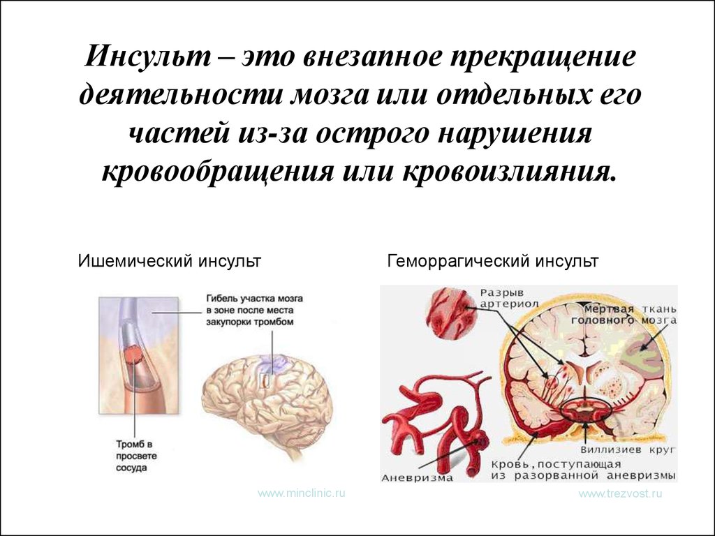 Поражение головного мозга при инсульте. Инсульт. Причины мозгового инсульта. Предпосылки ишемического инсульта.