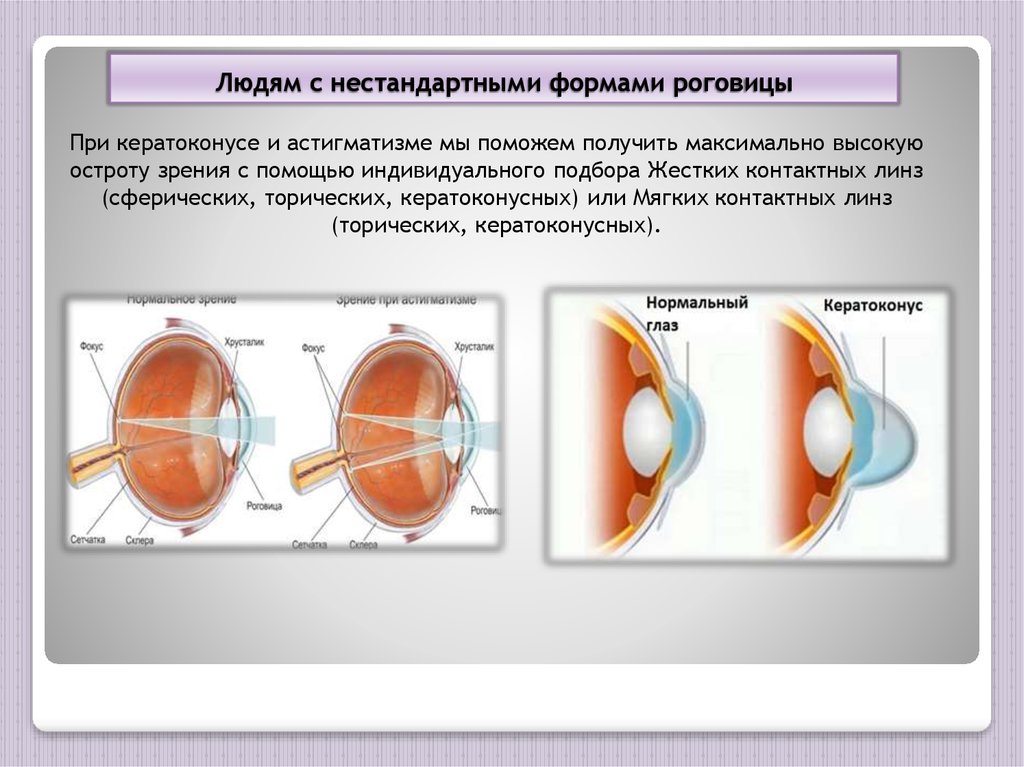 Людям с нестандартными формами роговицы