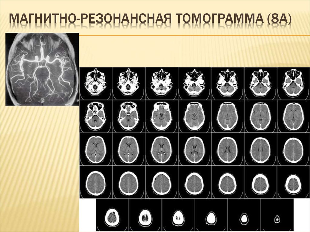 Але кт. Режимы кт. Томограмма. Индекс Эванса на кт.