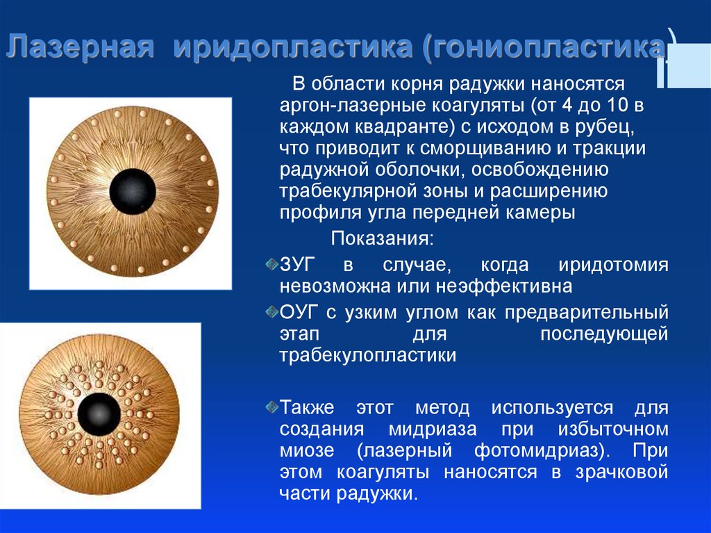 Иридотомия. Лазерная иридопластика. Лазерная гониопластика. Лазерная гониопластика при глаукоме. Лазеры в офтальмологии презентация.