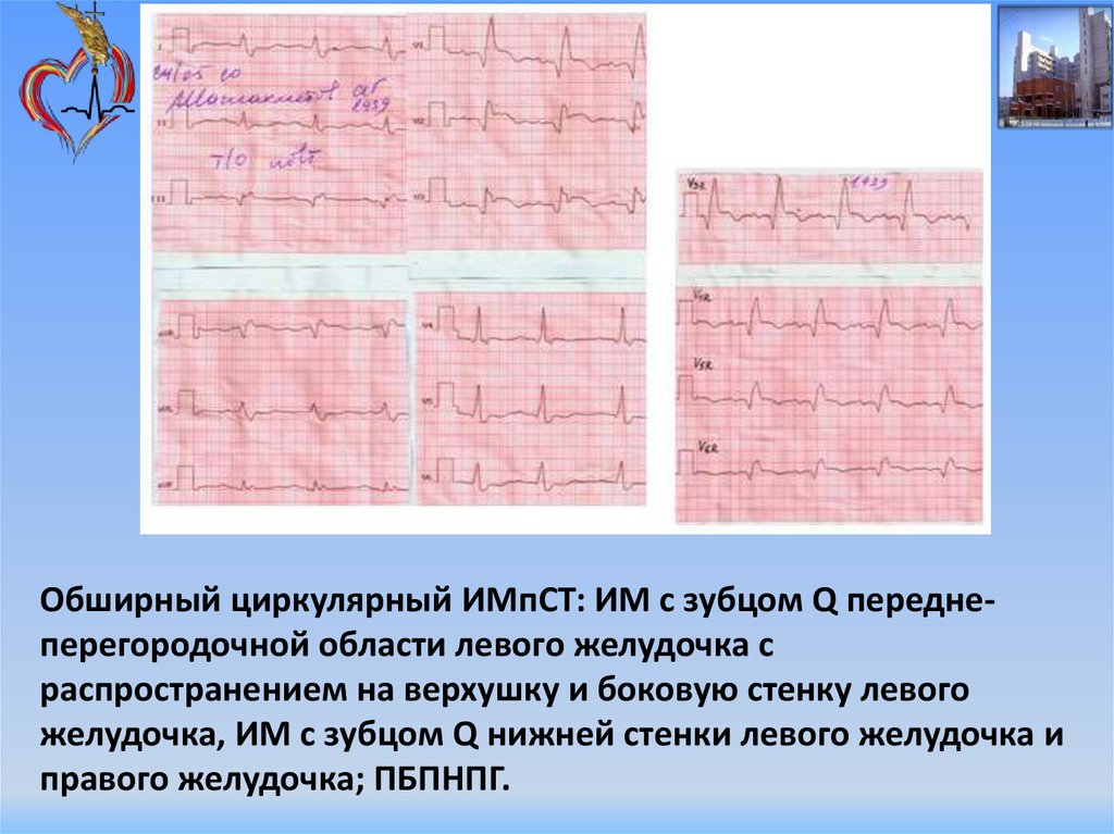 Изменения миокарда левого желудочка сердца. Передне перегородочная область. Рубцовые изменения боковой стенки. Рубцовые изменения передней стенки. Рубцовые изменения нижней стенки на ЭКГ.