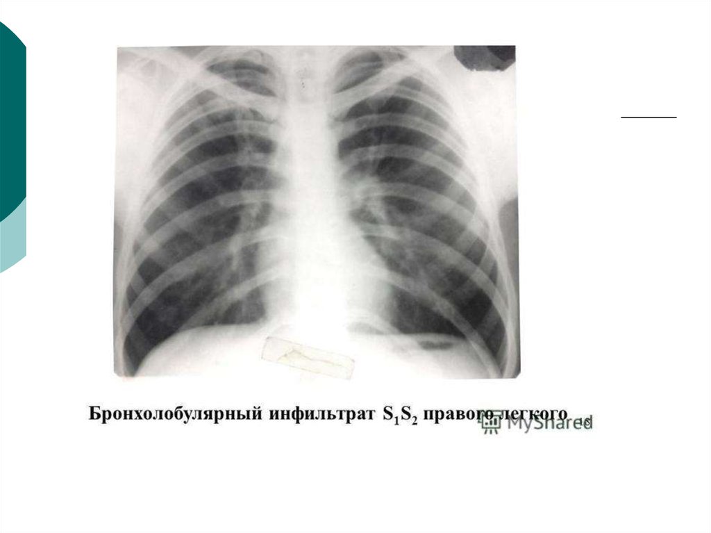 Округлый инфильтрат. Лобулярный инфильтративный туберкулез рентген. Инфильтративный туберкулез клиника. Инфильтративный туберкулёз с1 с2 с6. Инфильтративный туберкулез легких s1 s2.