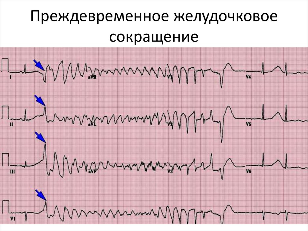 Желудочковая аритмия. Преждевременное желудочковое сокращение. Желудочковые сокращения. ЭКГ практикум. Кардиограмапреждевременные сокращения.