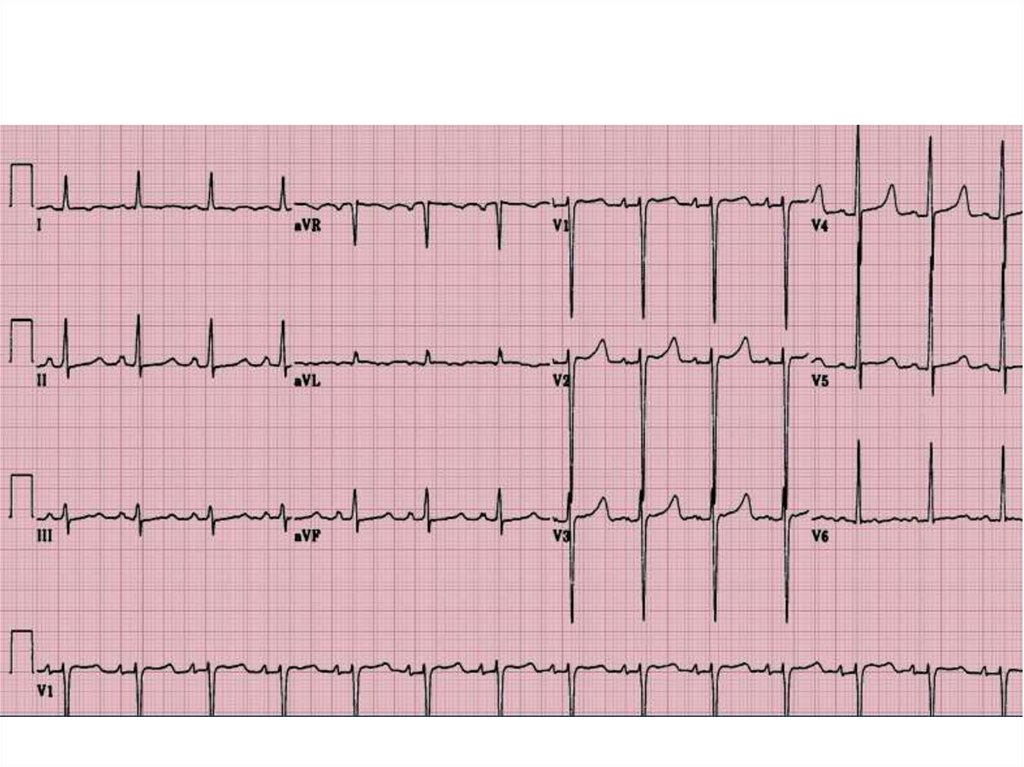 Экг пациентов. ЭКГ ECG-1112. Кардиограмма здорового человека и больного. Кардиограмма здорового сердца. Кардиограмма больного человека.