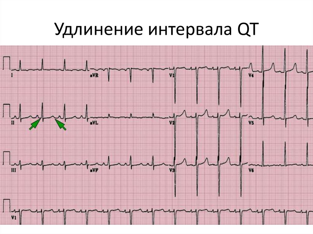 Удлинение интервала qt