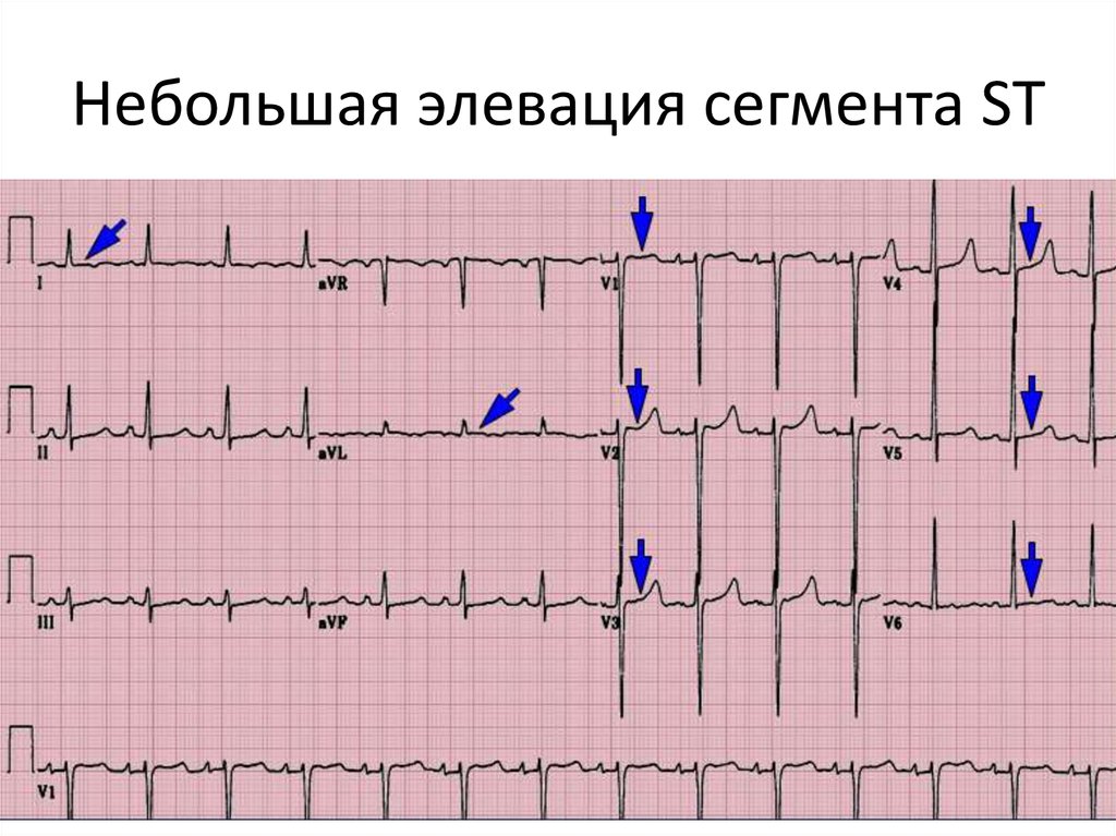 Сегменты экг