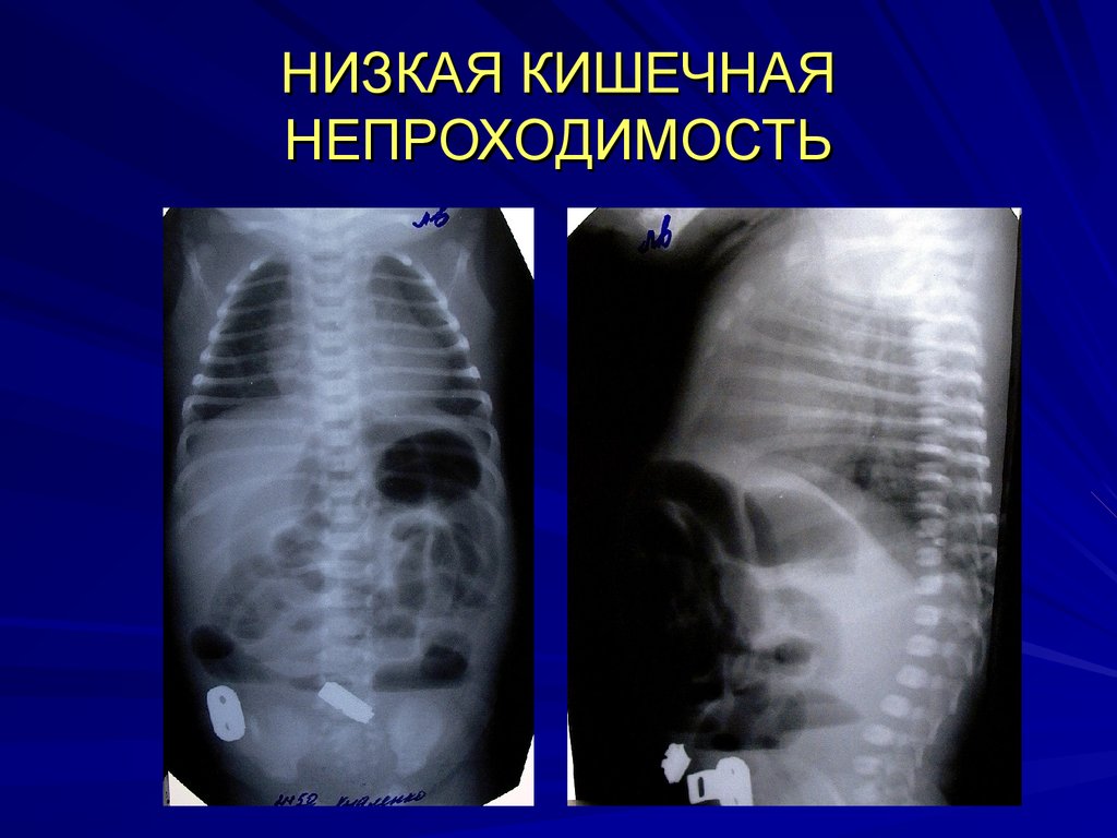 Кишечная непроходимость. Врожденная высокая кишечная непроходимость рентген. Врожденная тонкокишечная непроходимость. Врожденная низкая кишечная непроходимость рентген. Высокая и низкая кишечная непроходимость рентген.