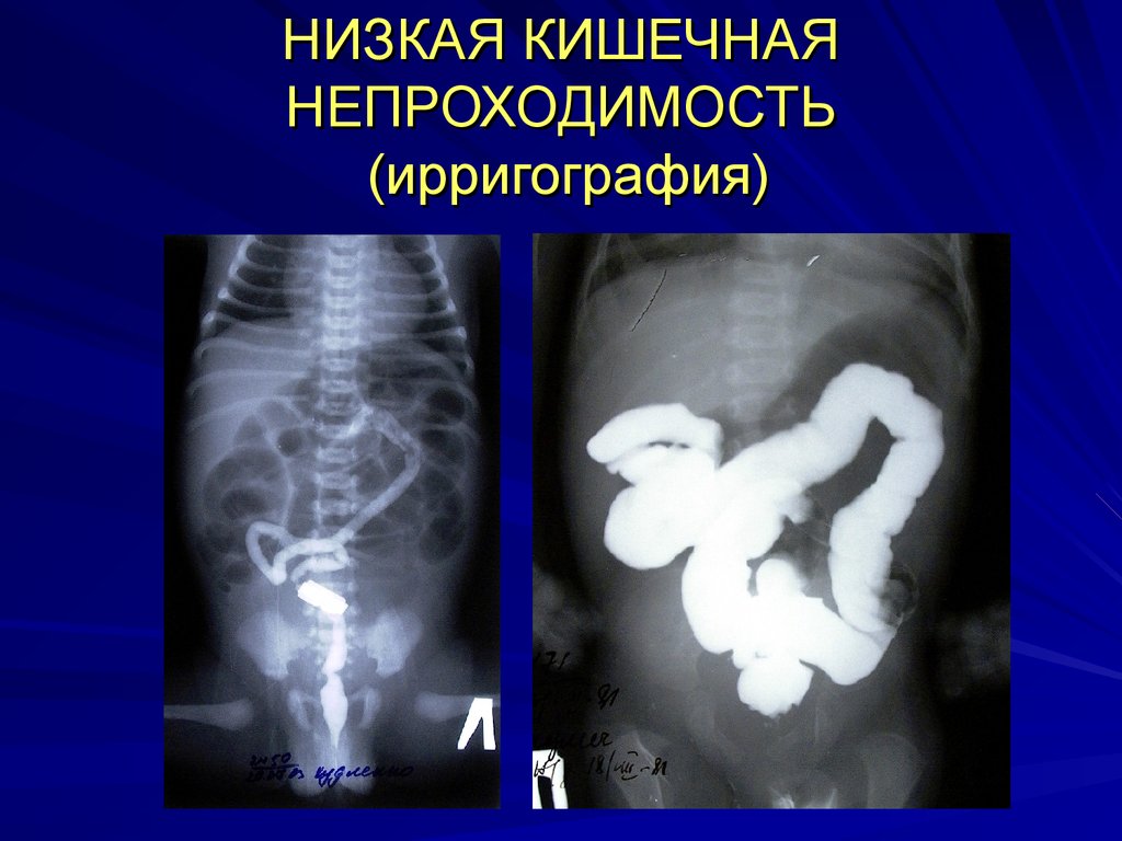 Острая кишечная непроходимость госпитальная хирургия презентация