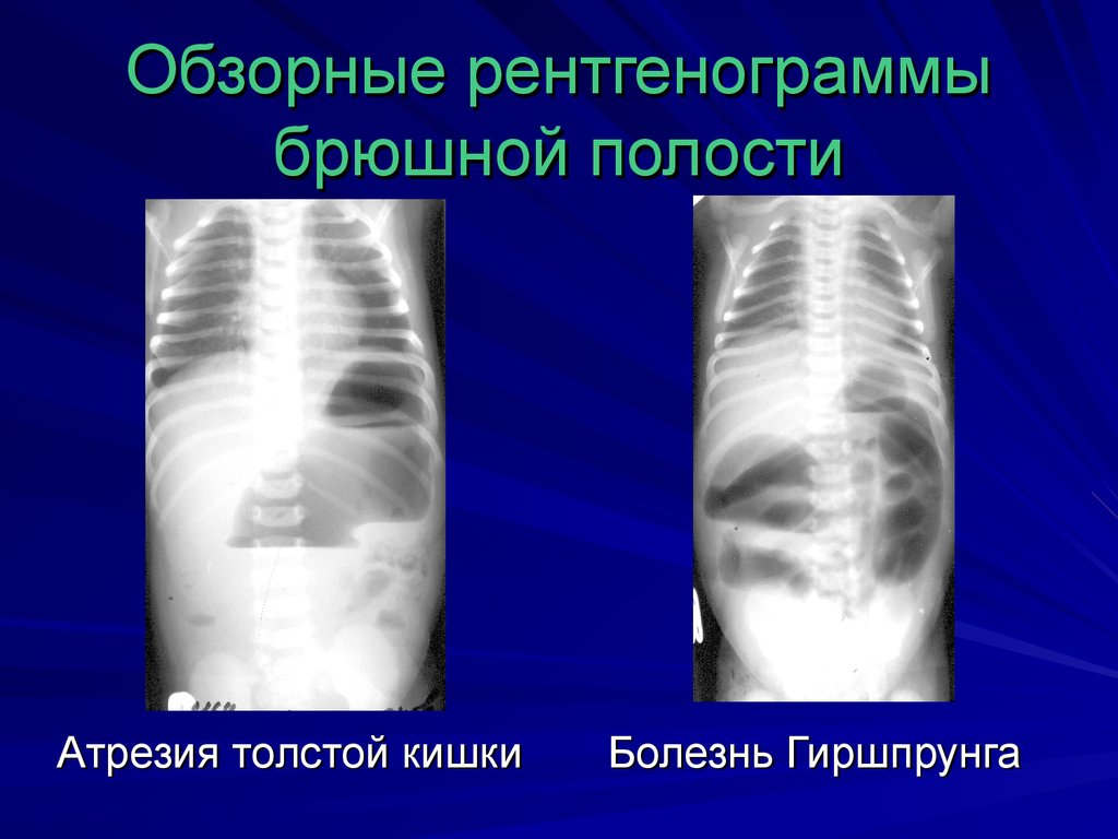 Обзорные рентгенограммы брюшной полости