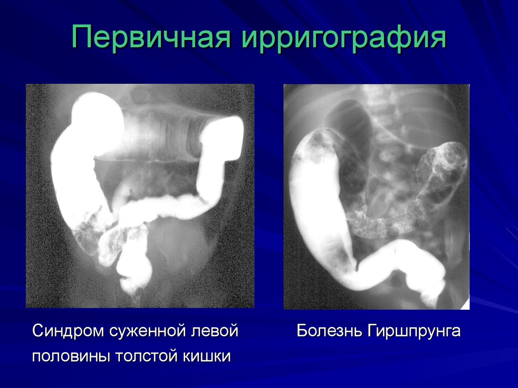 Первичная ирригография