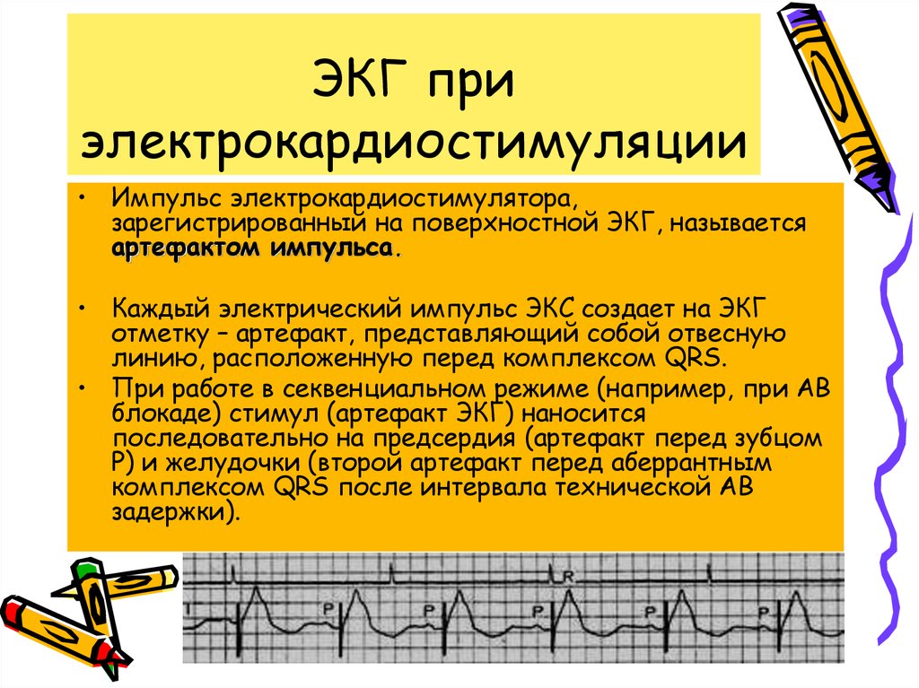 Экг с кардиостимулятором картинки