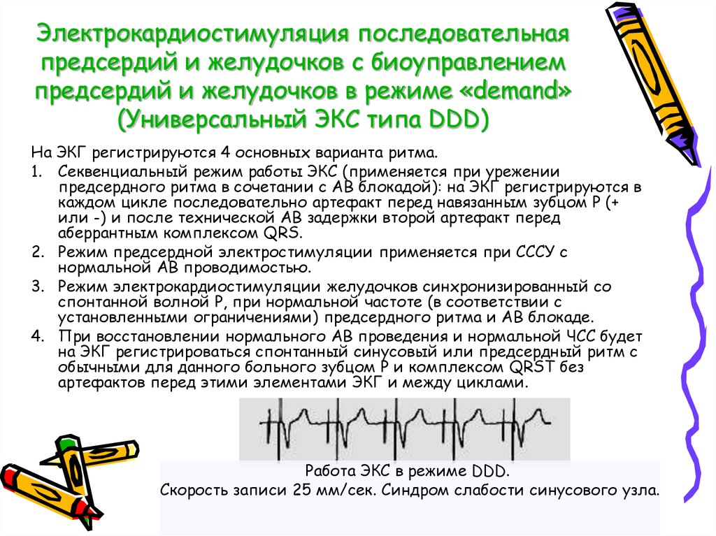 Режимы работы экс. Режимы кардиостимуляторов. Режимы работы кардиостимулятора. Режимы кардиостимуляции на ЭКГ. Виды электрокардиостимуляции.