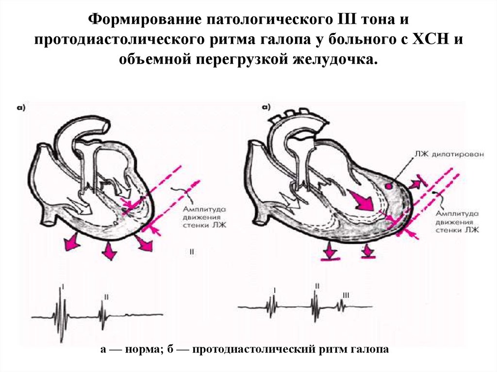 Ритм галопа. Ритм галопа при митральной недостаточности. Ритм галопа при сердечной недостаточности. Ритм галопа при аортальной недостаточности. Недостаточность митрального клапана ритм галопа.