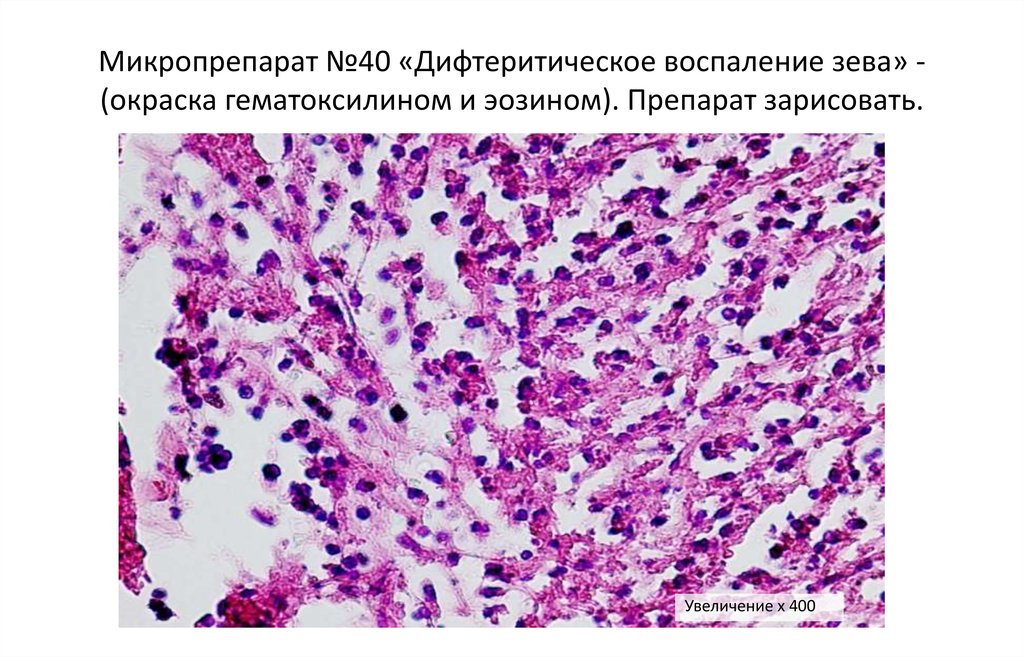 Дифтерия микроскопическая картина