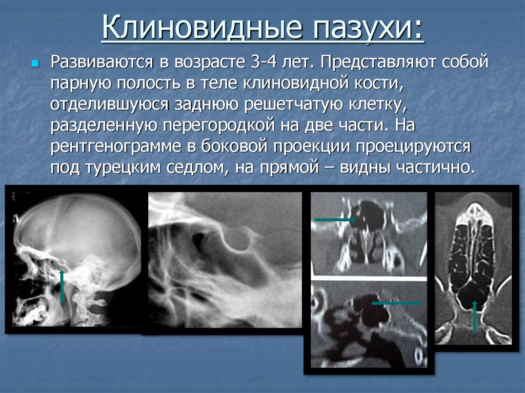 Клиновидная пазуха. Аномалия развития клиновидной пазухи. Клиновидная пазуха анатомия. Пневматизация клиновидной пазухи.