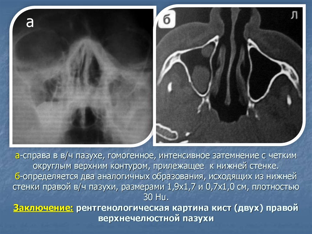 Мр картина полисинусита