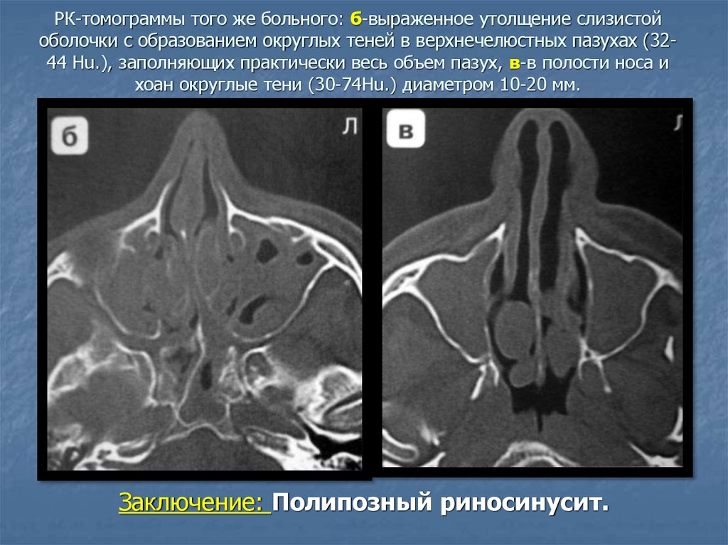 Полипозный риносинусит кт картина