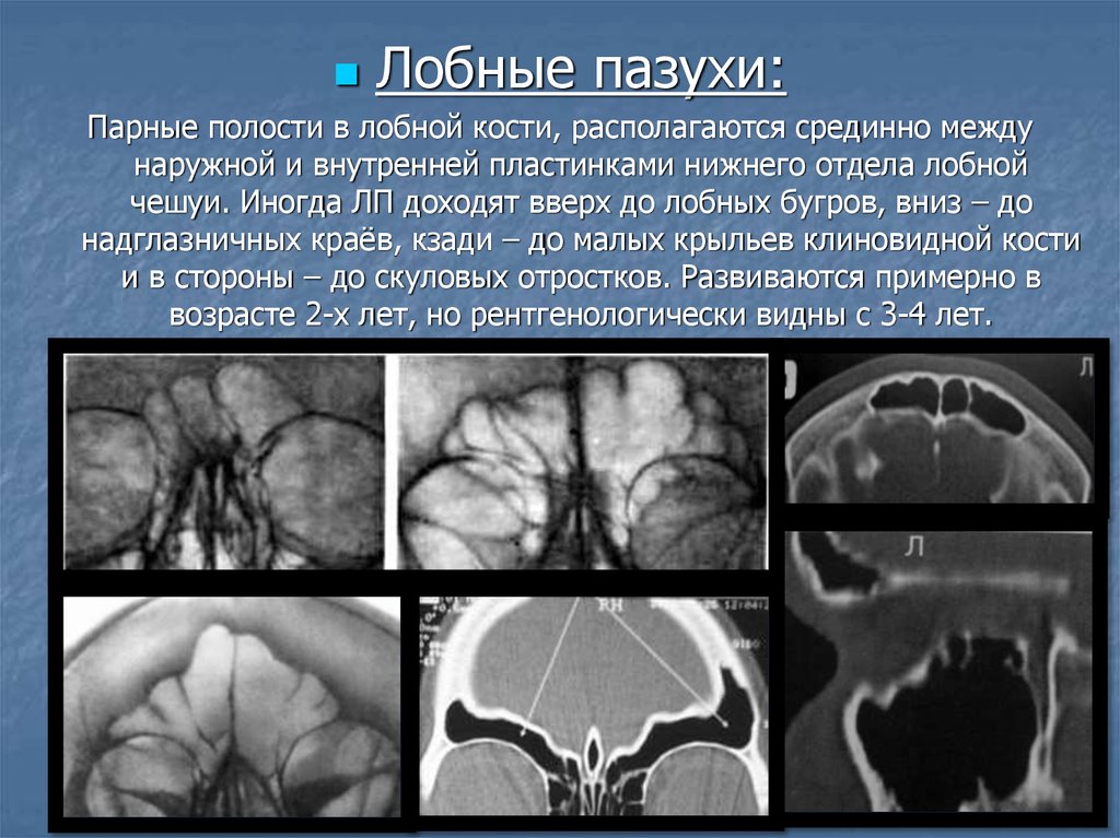 Лобная пазуха. Аплазия лобной пазухи кт. Гипоплазия лобной пазухи на кт. Гипоплазия лобных пазух рентген. Недоразвитие лобных пазух.