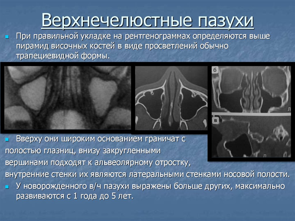 Анатомия верхнечелюстной пазухи презентация