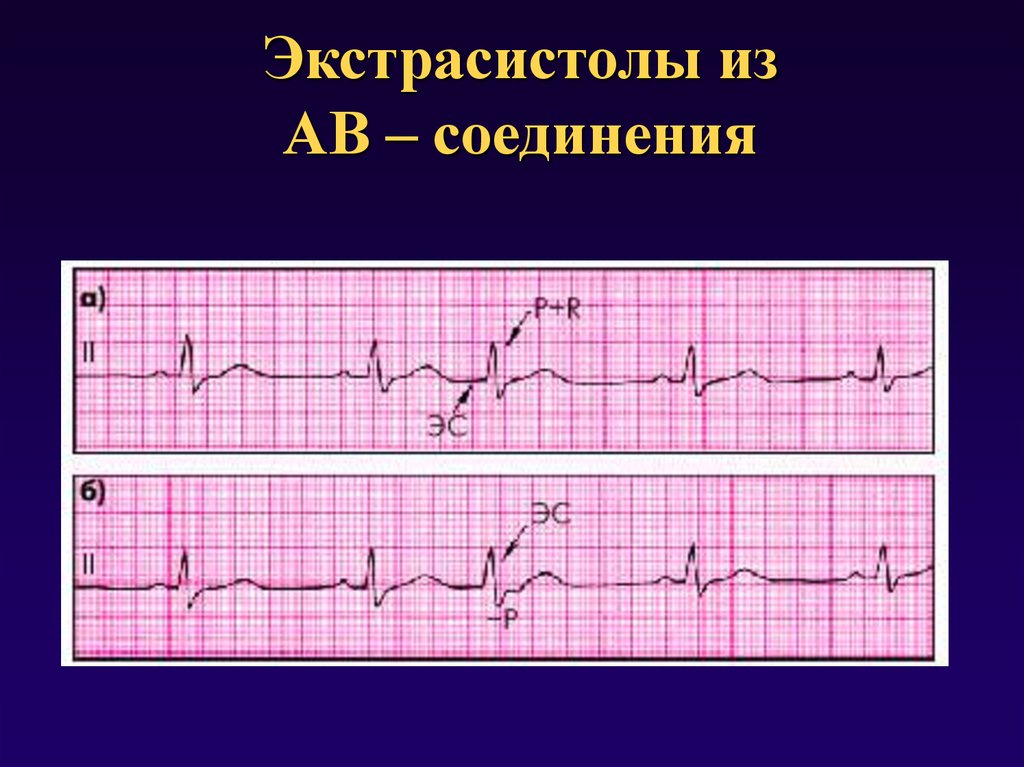 Экстрасистолия на экг. АВ Узловая экстрасистолия на ЭКГ. Экстрасистолия АВ соединения на ЭКГ. Av Узловая экстрасистолия на ЭКГ. Экстрасистолы из атриовентрикулярного соединения.