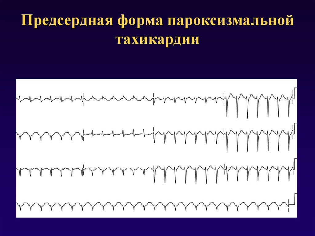 Пароксизмальная тахикардия презентация