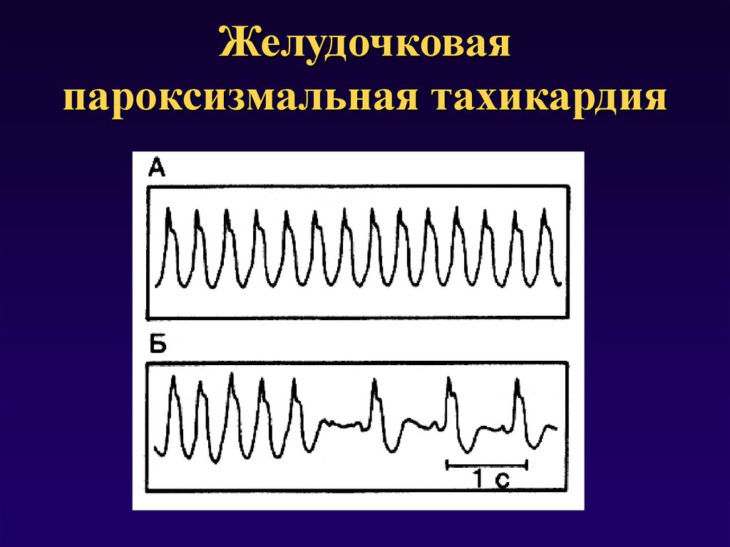 Фото желудочковая тахикардия