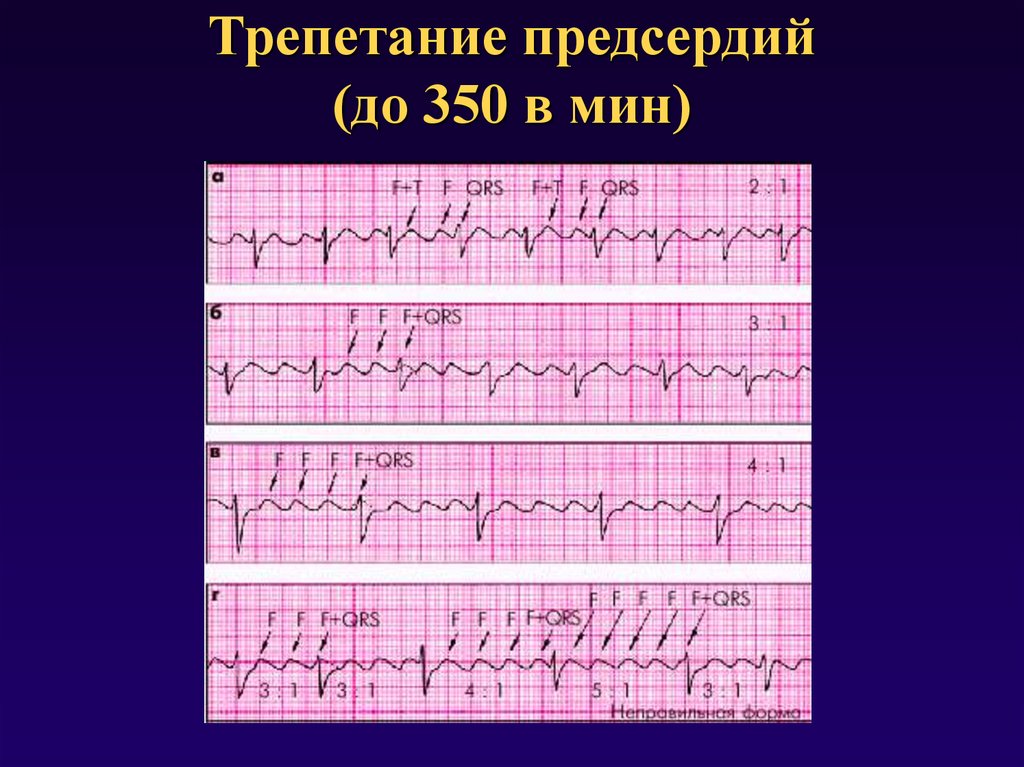 Типы трепетания предсердий. Трепетание предсердий 1 к 1 на ЭКГ. Трепетание предсердий 2 к 1 на ЭКГ. Пароксизм трепетания предсердий ЭКГ. Трепетание предсердий атипичная форма на ЭКГ.