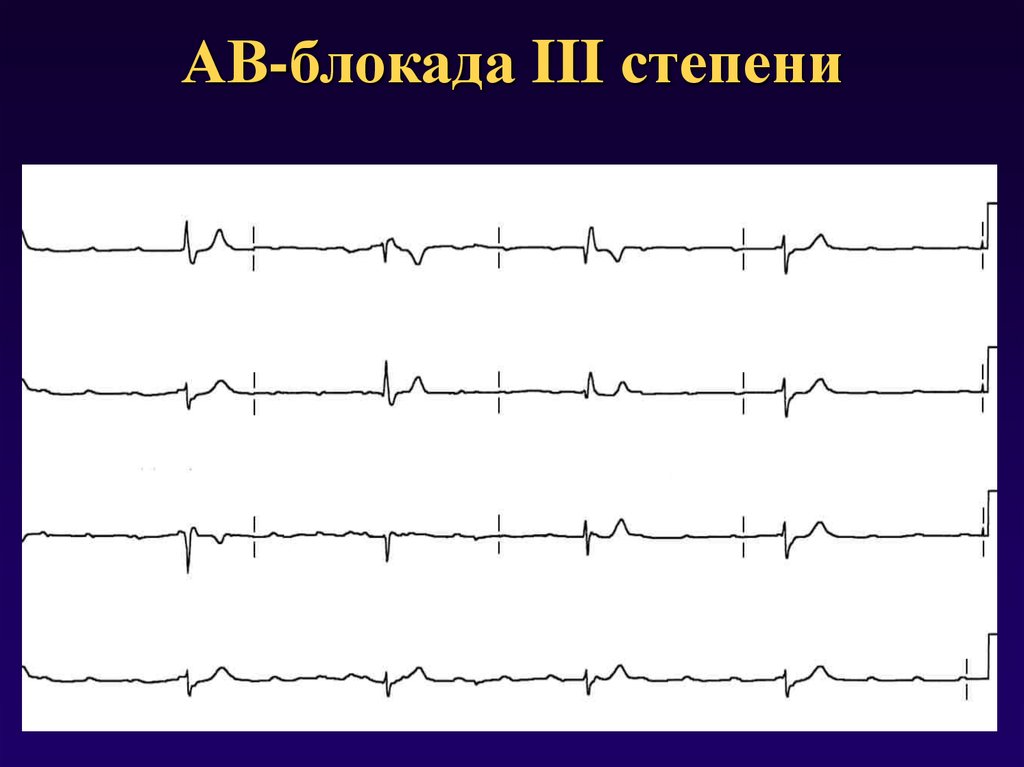 Ав блокада. АВ блокада 3 степени ритм. Av-блокада 111 степени.. Аб блокада 3 степени ЭКГ. АВ блокада 3 степени на ЭКГ.