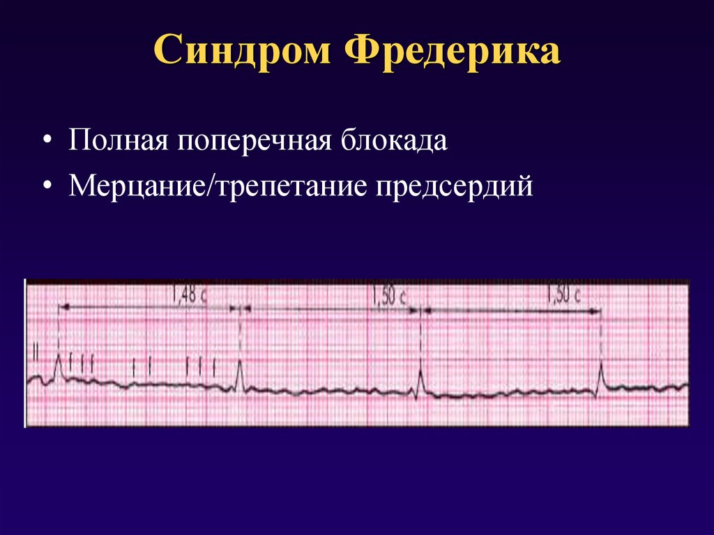 Синдром фредерика на экг фото