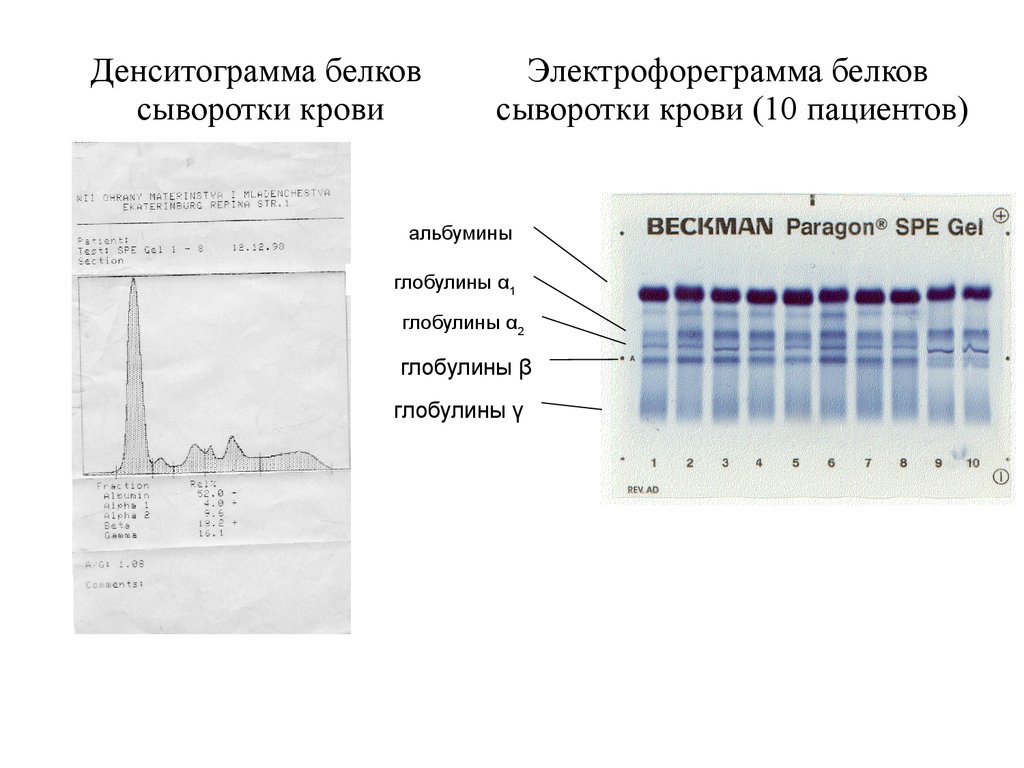 Электрофорез белков. Электрофорез белковых фракций крови. Электрофореграмма белков плазмы крови норма. Электрофореграмма белков сыворотки крови. Электрофорегремма белков сыврортка крови.