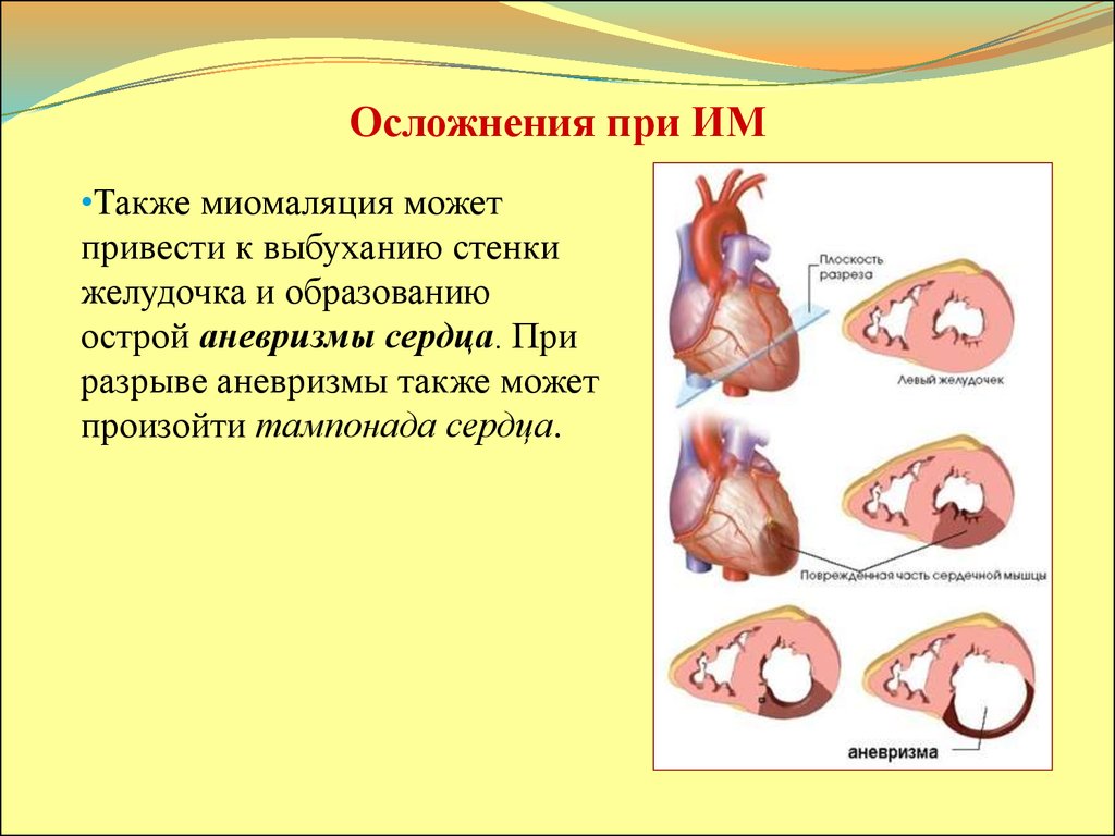 Воспалительные заболевания сердца презентация