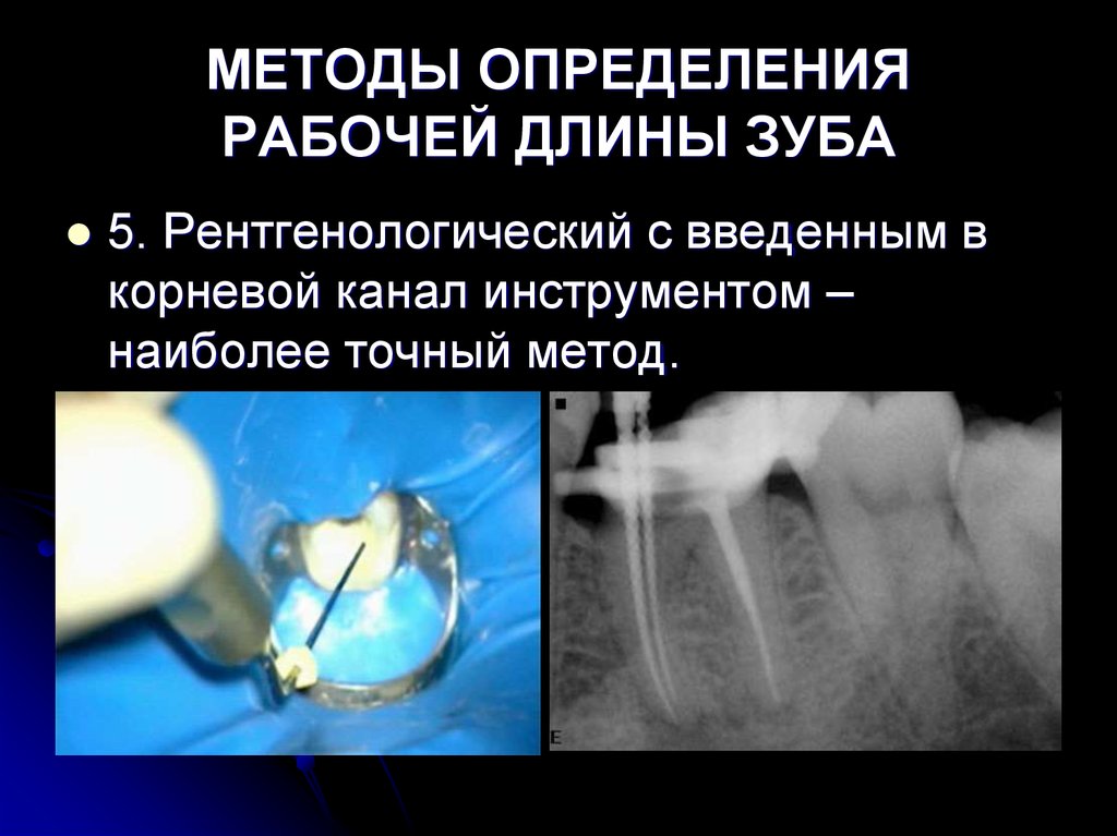 Методы лечения зубов с проблемными корневыми каналами презентация