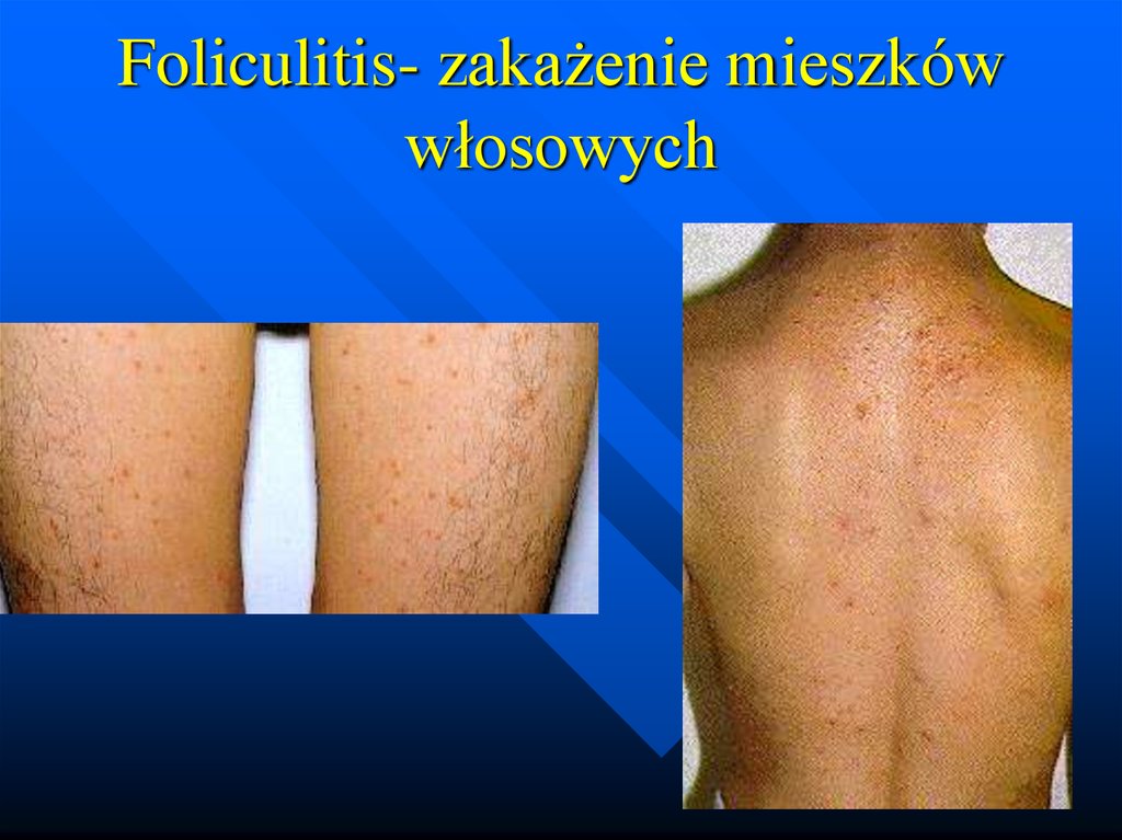 Zapalne Choroby Powłok I Zakażenia Przyranne презентация онлайн 0247