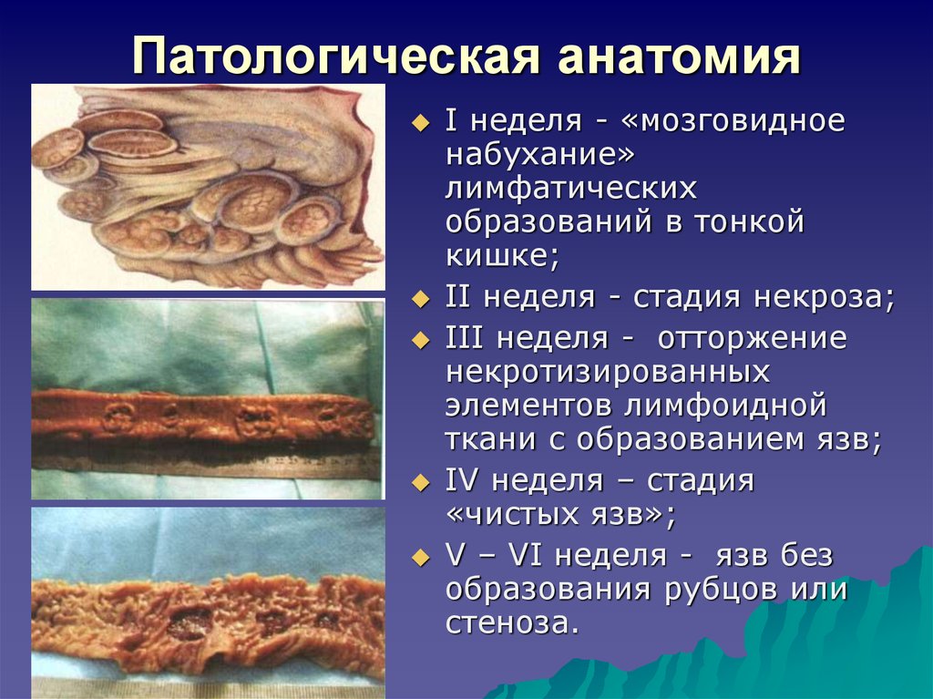 Патологическая анатомия это. Брюшной тиф патанатомия. Патологическая анатомия кишечник макропрепарат. Тонкая кишка макропрепарат.