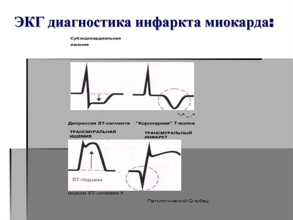 Диагностика инфаркта