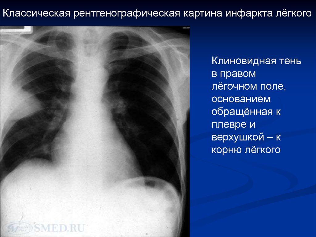 Тромбоэмболия легочной артерии пневмония. Тэла инфаркт пневмония. Инфаркт легкого при Тэла рентген. Рентгенодиагностика Тэла. Тромбоэмболия на рентгене легких.