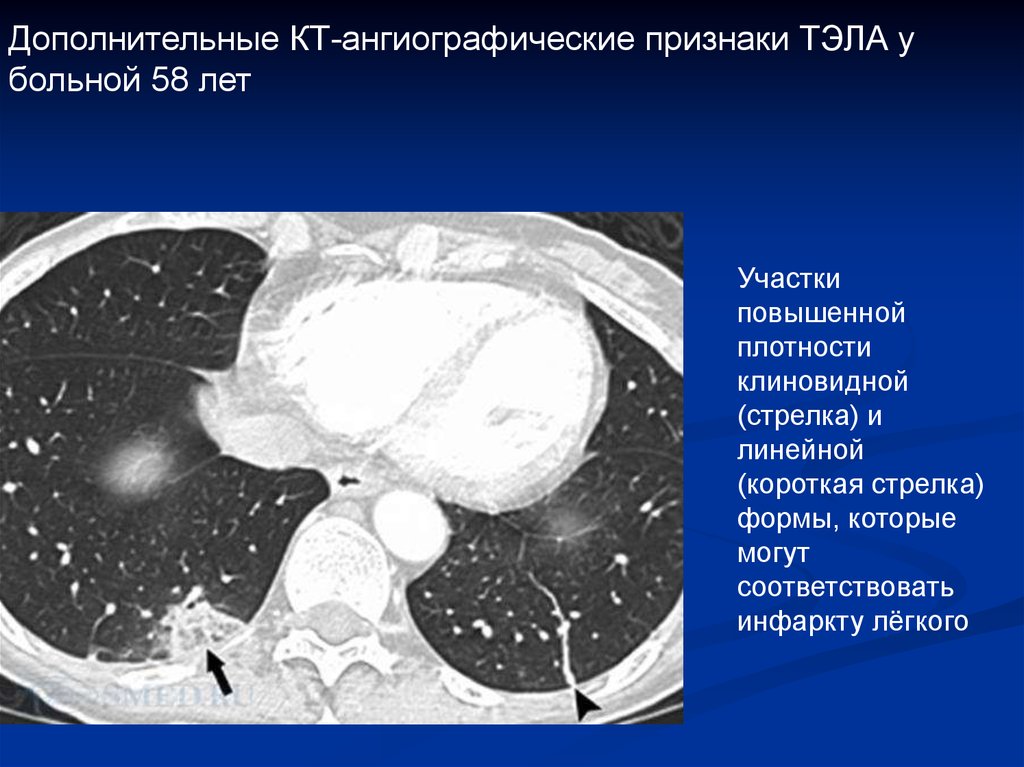 Кт признаки. Тромбоз легочной артерии на кт. Инфаркт-пневмония легкого на кт.