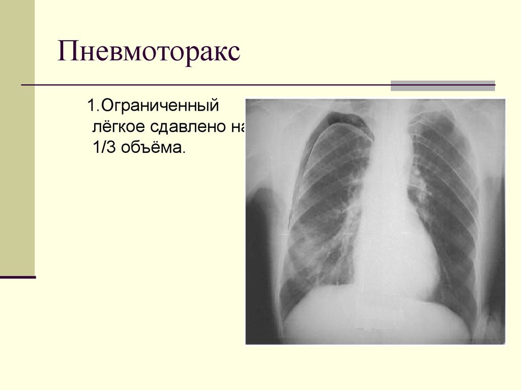 Пневмоторакс картинки для презентации