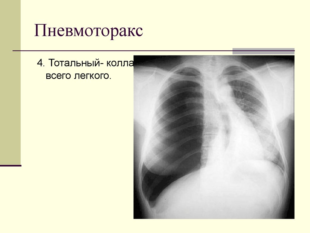 Пневмоторакс легких что это