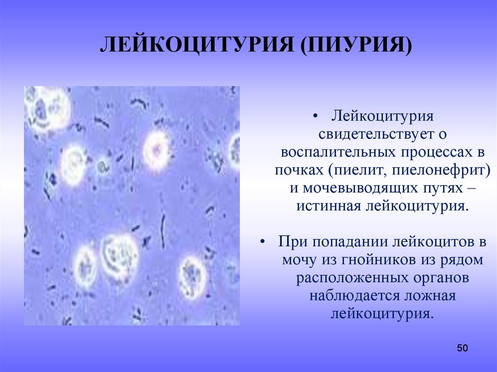 Симптомы лейкоцитурии