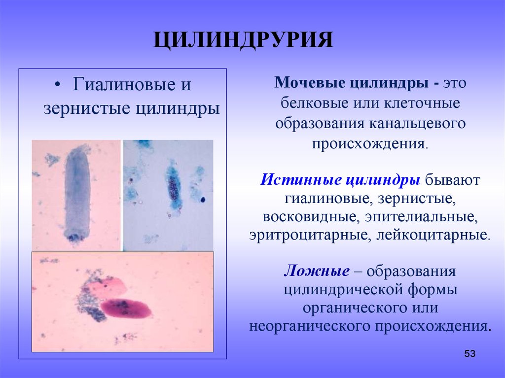 Цилиндрурия в моче. Гиалиновые и зернистые цилиндры. Цилиндрурия. Зернистые и восковидные цилиндры.