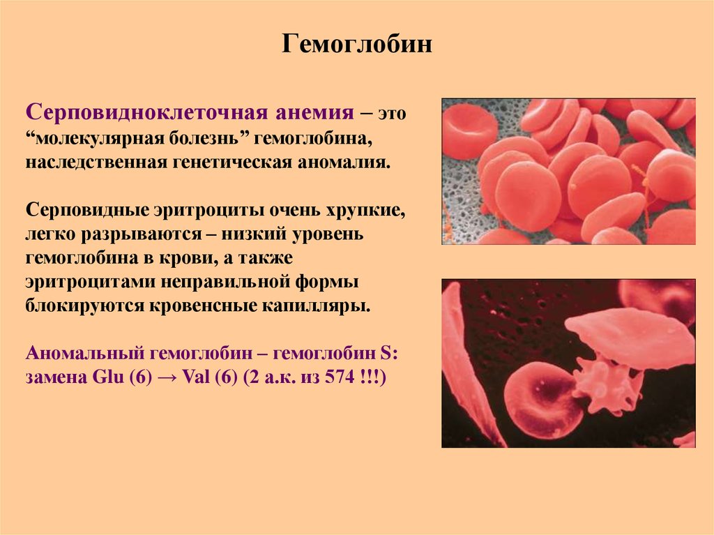 Анемия и эритроциты в крови. Гемоглобин серповидноклеточная анемия. Гемоглобин человека с серповидноклеточной анемии. Серповидноклеточная анемия эритроциты. Гемоглобин и Эритройит.