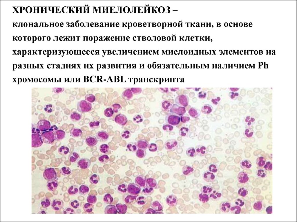 Хронический миелолейкоз. Острый миелоидный лейкоз картина крови. Миелоидный лейкоз гистология. Хронический миелобластный лейкоз мазок крови. Хроническом миелолейкозе картина крови.