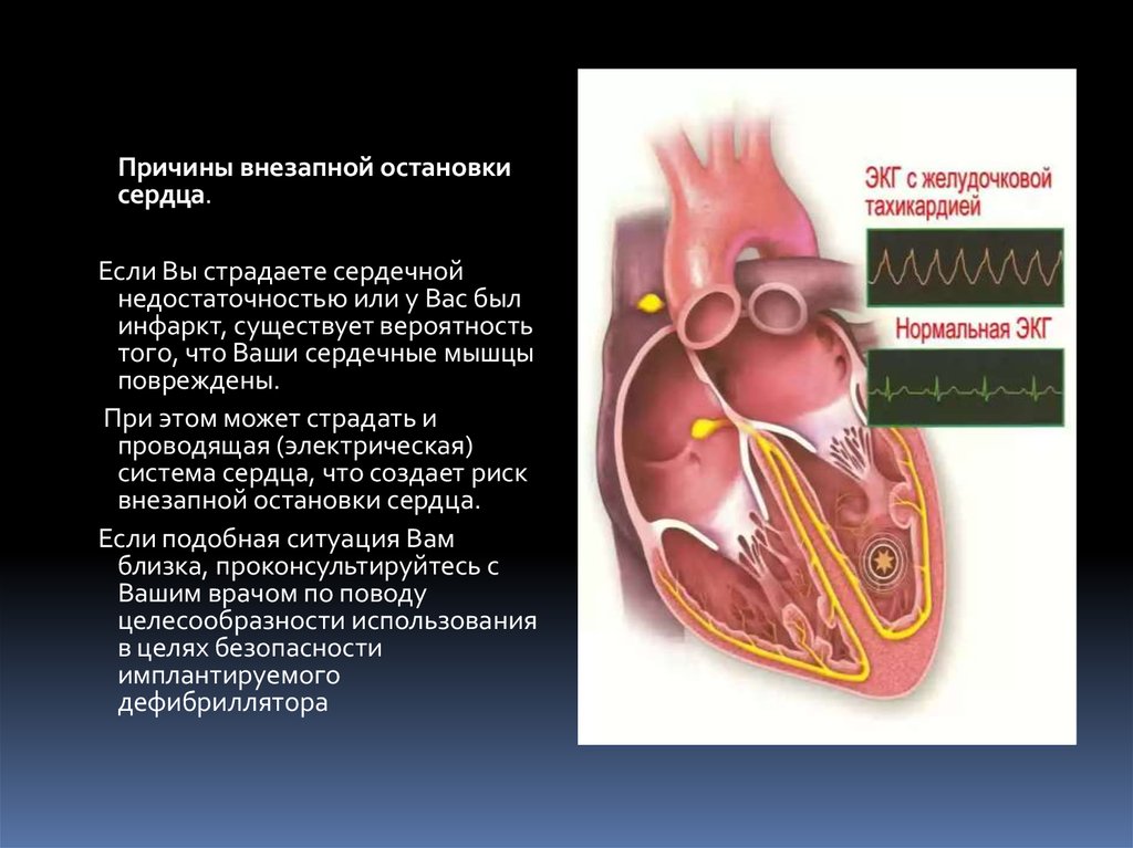 Может ли остановиться сердце. Причины внезапной остановки сердца. От чего может остановится сердце. Почему может остановится сердце. Причины внезапной остановки сердца у здорового человека.