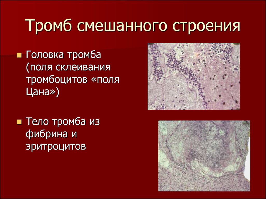 Виды тромбоза. Строение смешанного тромба. Тромб строение головка. Смешанный тромб головка тело и хвост.