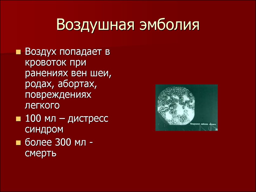 Воздушная эмболия осложнения. Воздушная эмболия при внутривенных инъекциях. Воздушная эмболия симптомы. Воздушная эмболия при ранении вен.