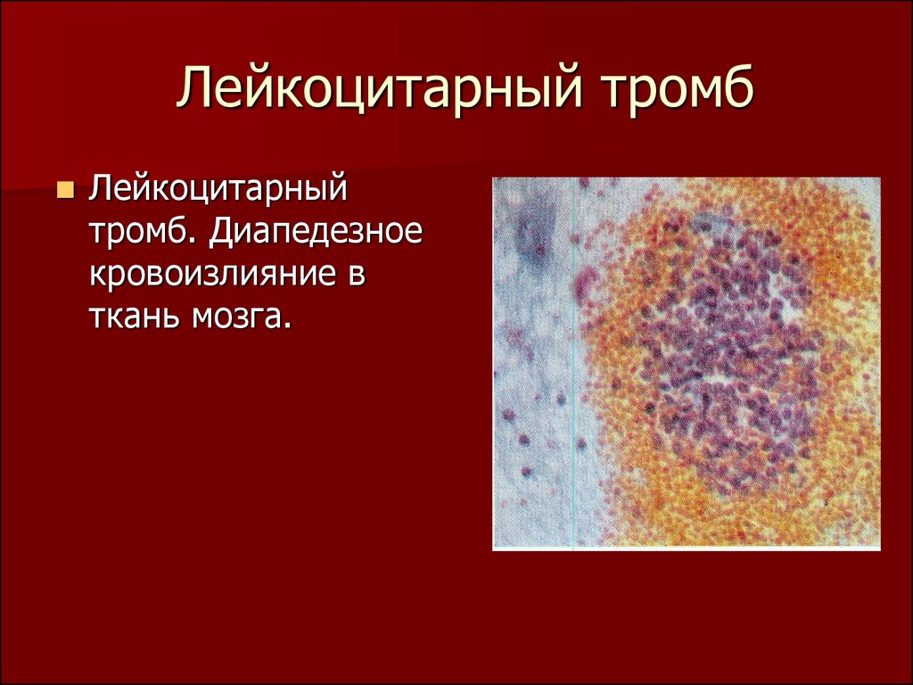Лейкоцитарный тромб