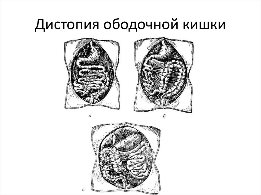 Дистопия ободочной кишки