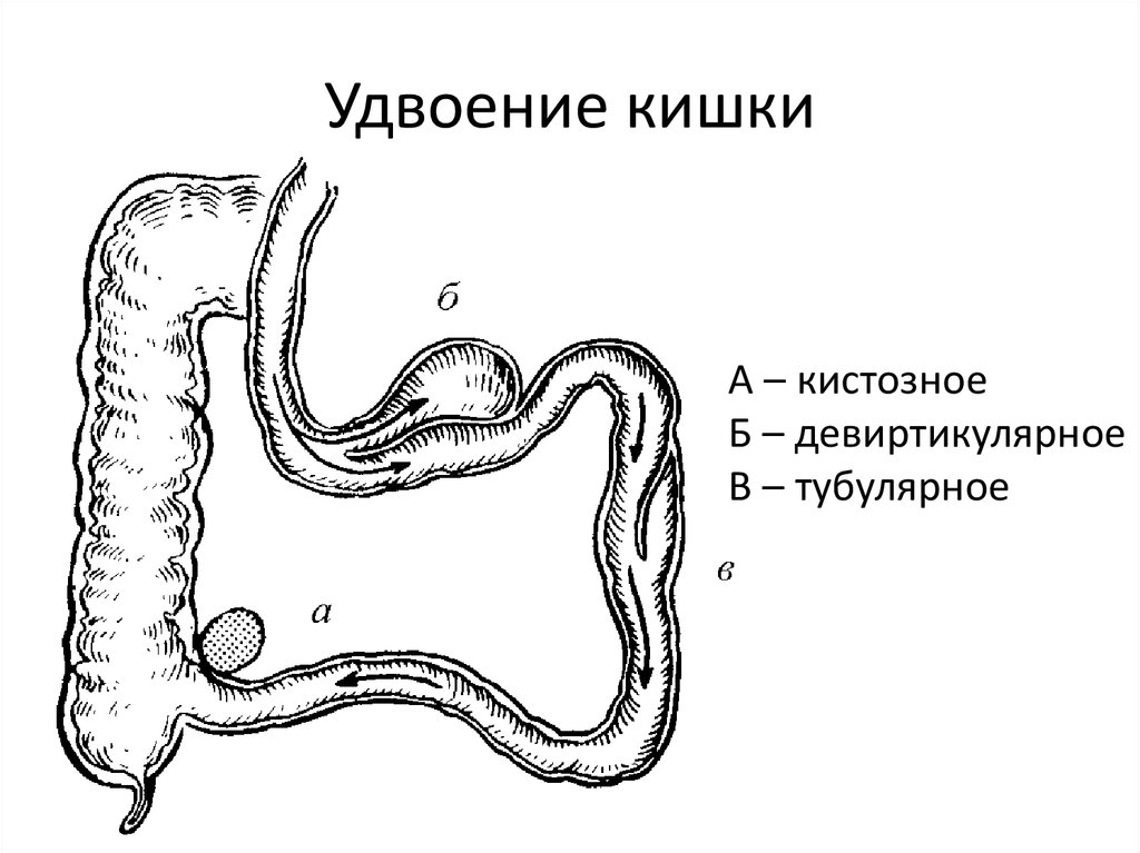 Развитие желудка. Удвоение подвздошной кишки. Удвоение двенадцатиперстной кишки. Пороки развития тонкого кишечника. Удвоение толстой кишки.